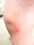 Bryn's mortal wound (he scraped his knee):